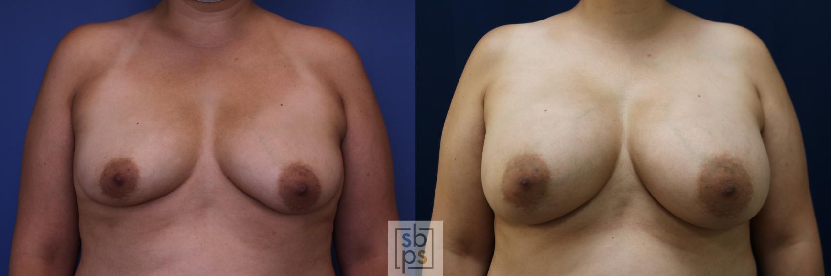 Before & After Breast Augmentation Case 684 Front View in Torrance, CA