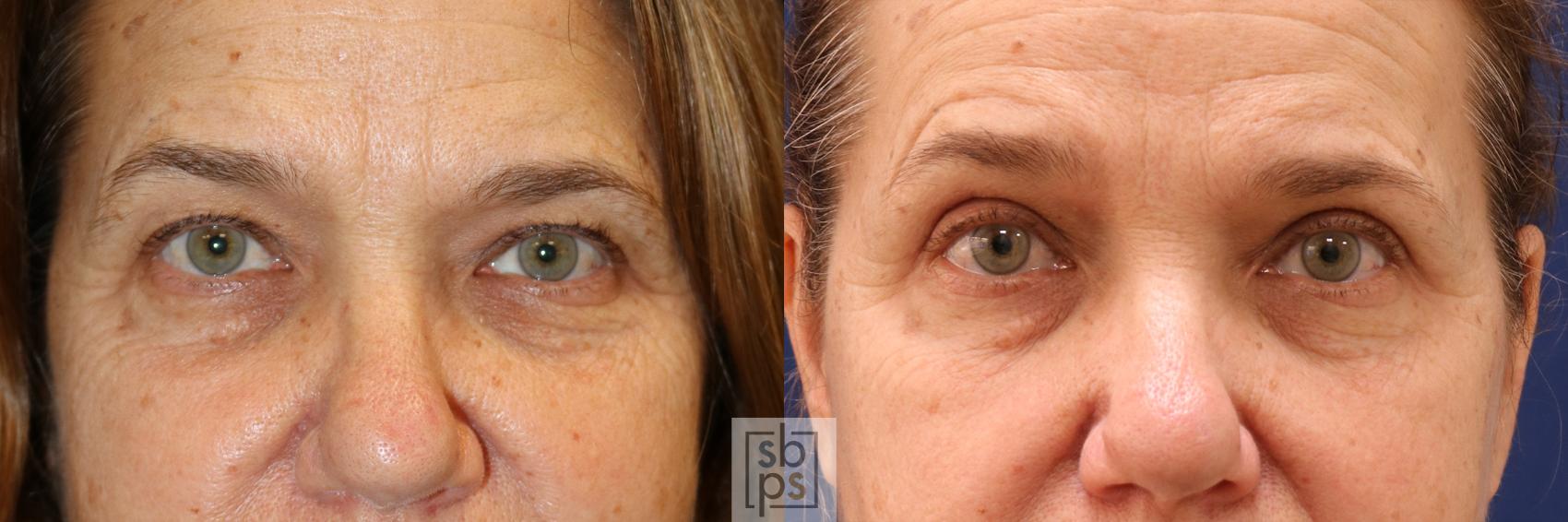 Before & After Eyelid Surgery (Blepharoplasty) Case 562 Front View in Torrance, CA