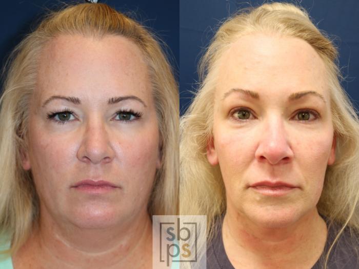 Before & After Eyelid Surgery (Blepharoplasty) Case 747 Front View in Los Angeles, Torrance & Long Beach, CA