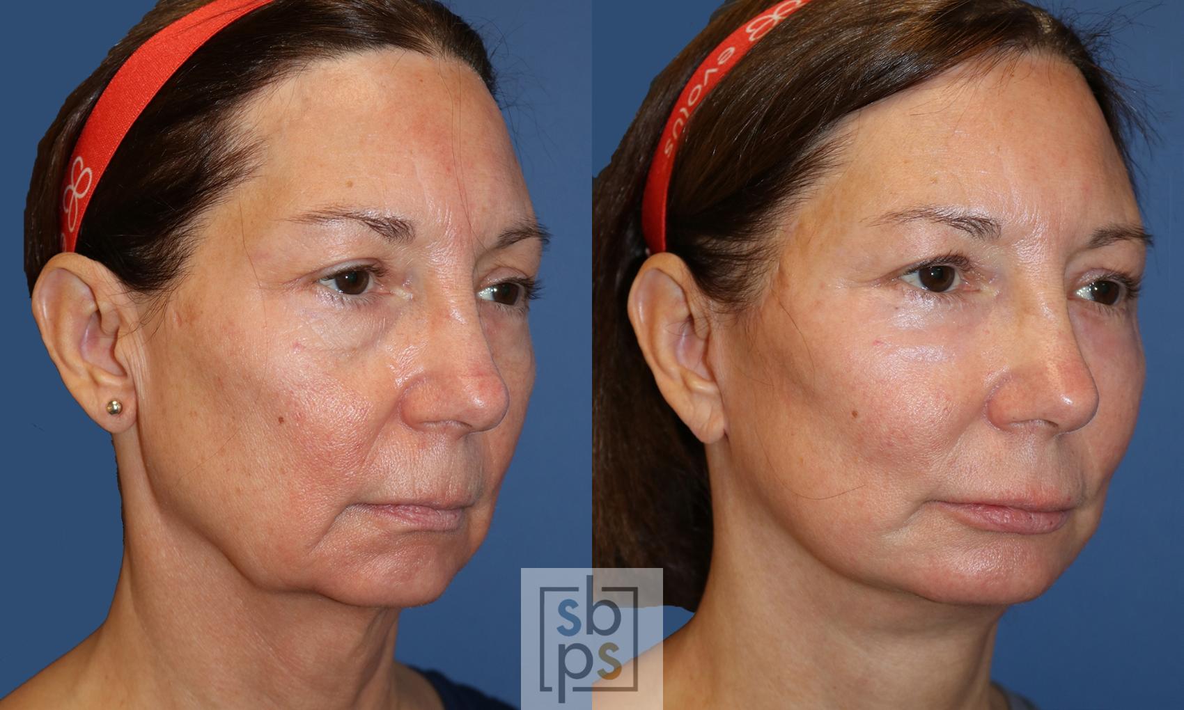Before & After Facelift Case 494 Right Oblique View in Torrance, CA