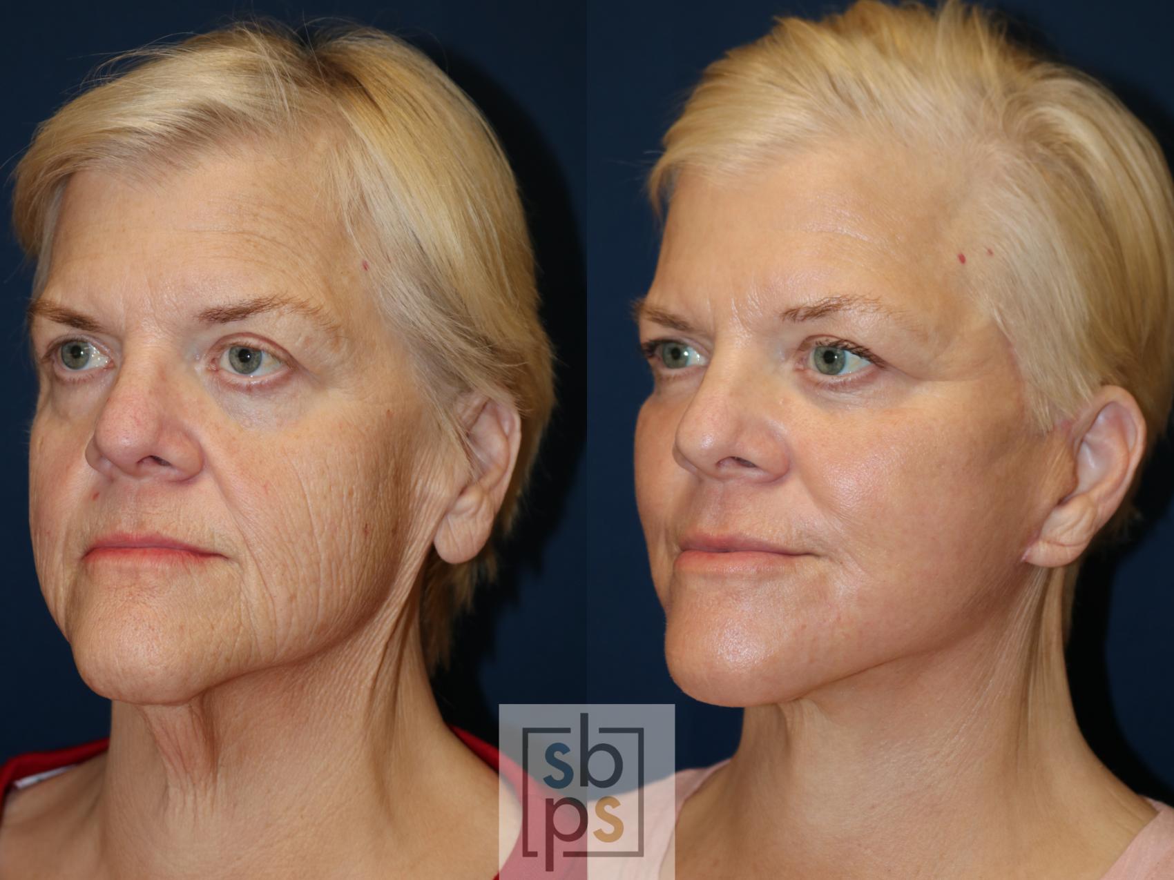 Before & After Facelift Case 682 Left Oblique View in Torrance, CA