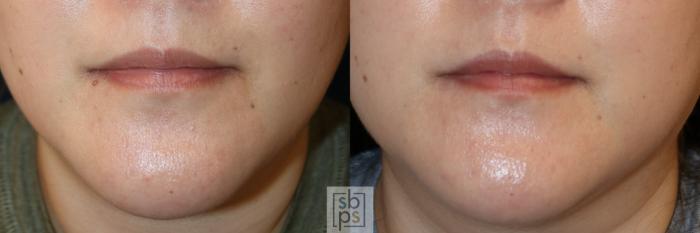 Before & After Lipoma & Mole Removal Case 745 Front View in Los Angeles, Torrance & Long Beach, CA