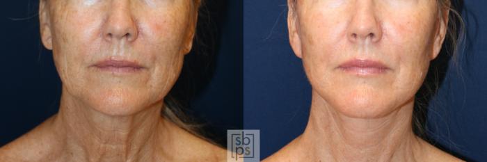 Before & After Neck Lift Case 736 Front View in Los Angeles & Torrance, CA, CA