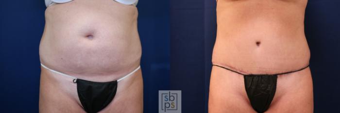 Before & After Tummy Tuck Case 755 Front View in Los Angeles, Torrance & Long Beach, CA