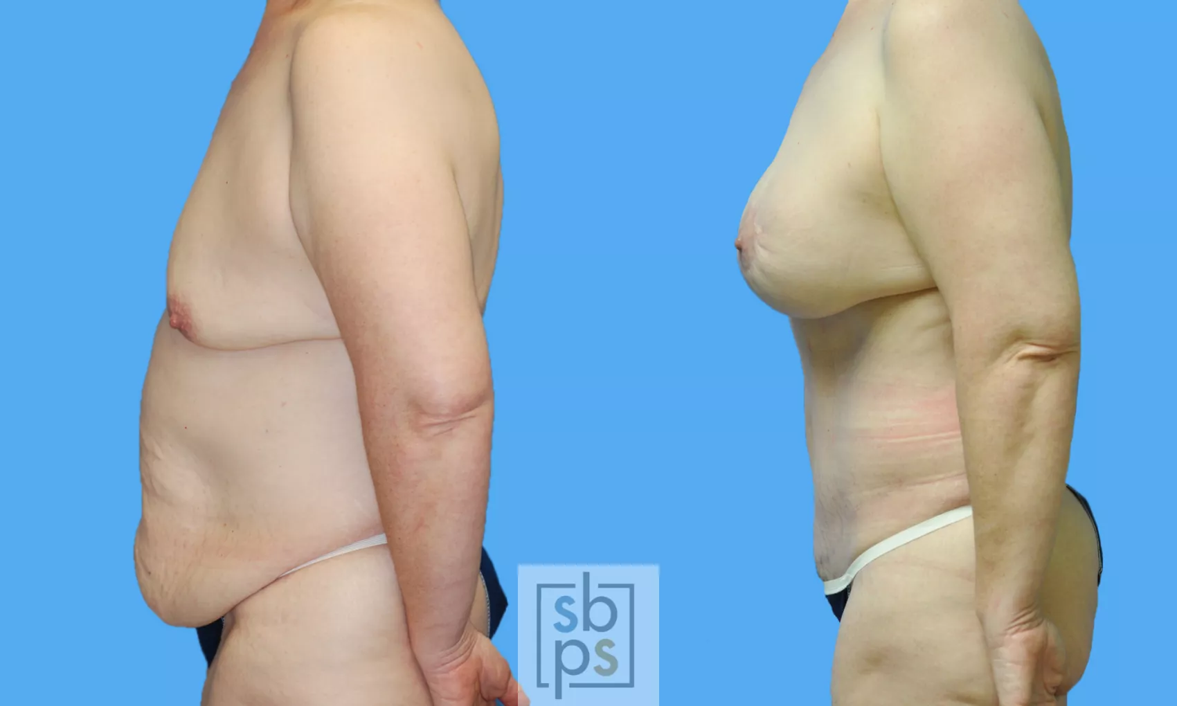Droopy Breasts After Losing Weight? Consider A Breast Lift