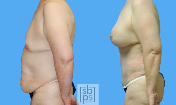 Before & After Breast Lift Case 121 View #1 View in Torrance, CA