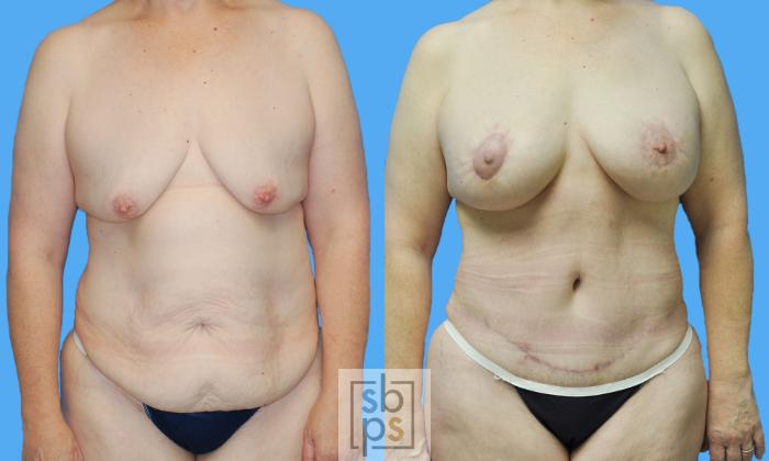 Before & After After Massive Weight Loss Case 121 View #2 View in Torrance, CA