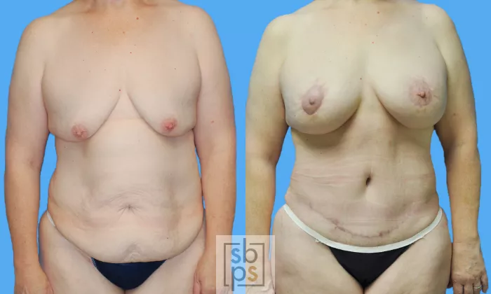 After Massive Weight Loss Before and After Pictures Case 121, Torrance, CA