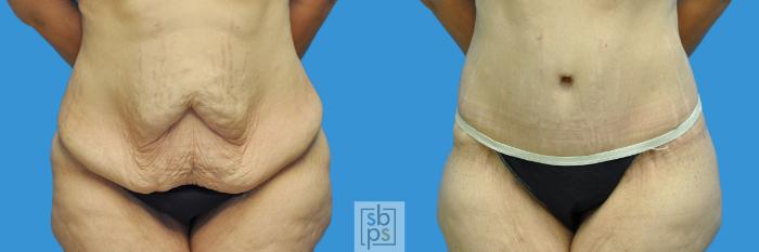 Before & After Tummy Tuck Case 124 View #1 View in Torrance, CA