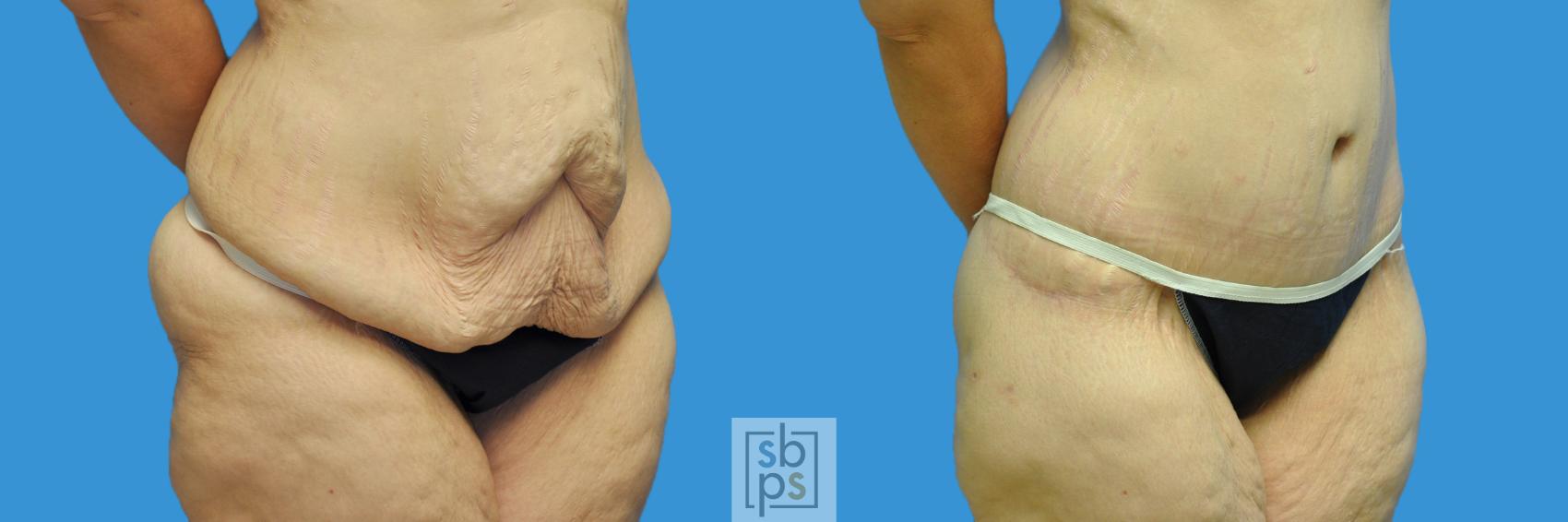 Before & After Tummy Tuck Case 124 View #2 View in Torrance & Los Angeles, CA, CA