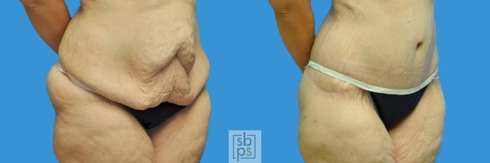 Before & After Tummy Tuck Case 124 View #2 View in Torrance, CA