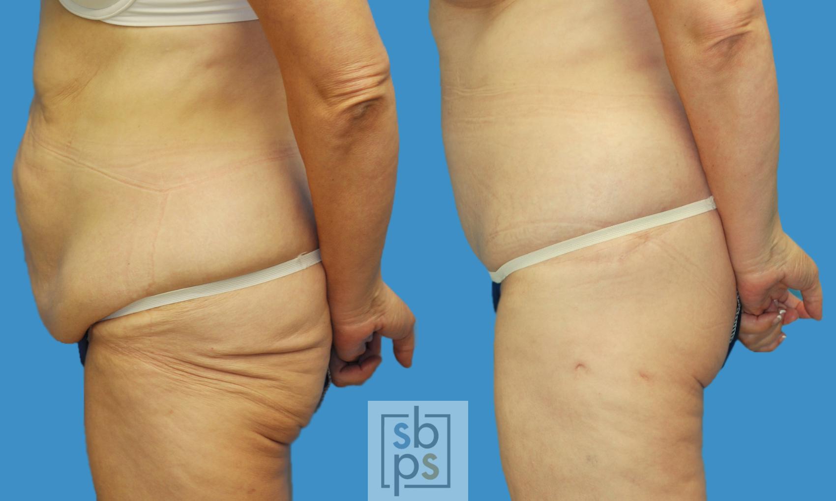 Before & After After Massive Weight Loss Case 146 View #2 View in Torrance, CA