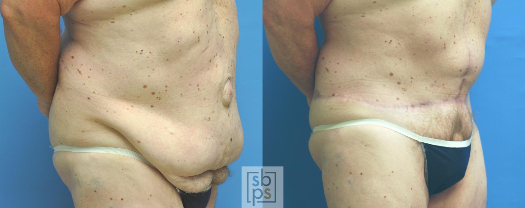 Before & After After Massive Weight Loss Case 152 View #2 View in Torrance, CA