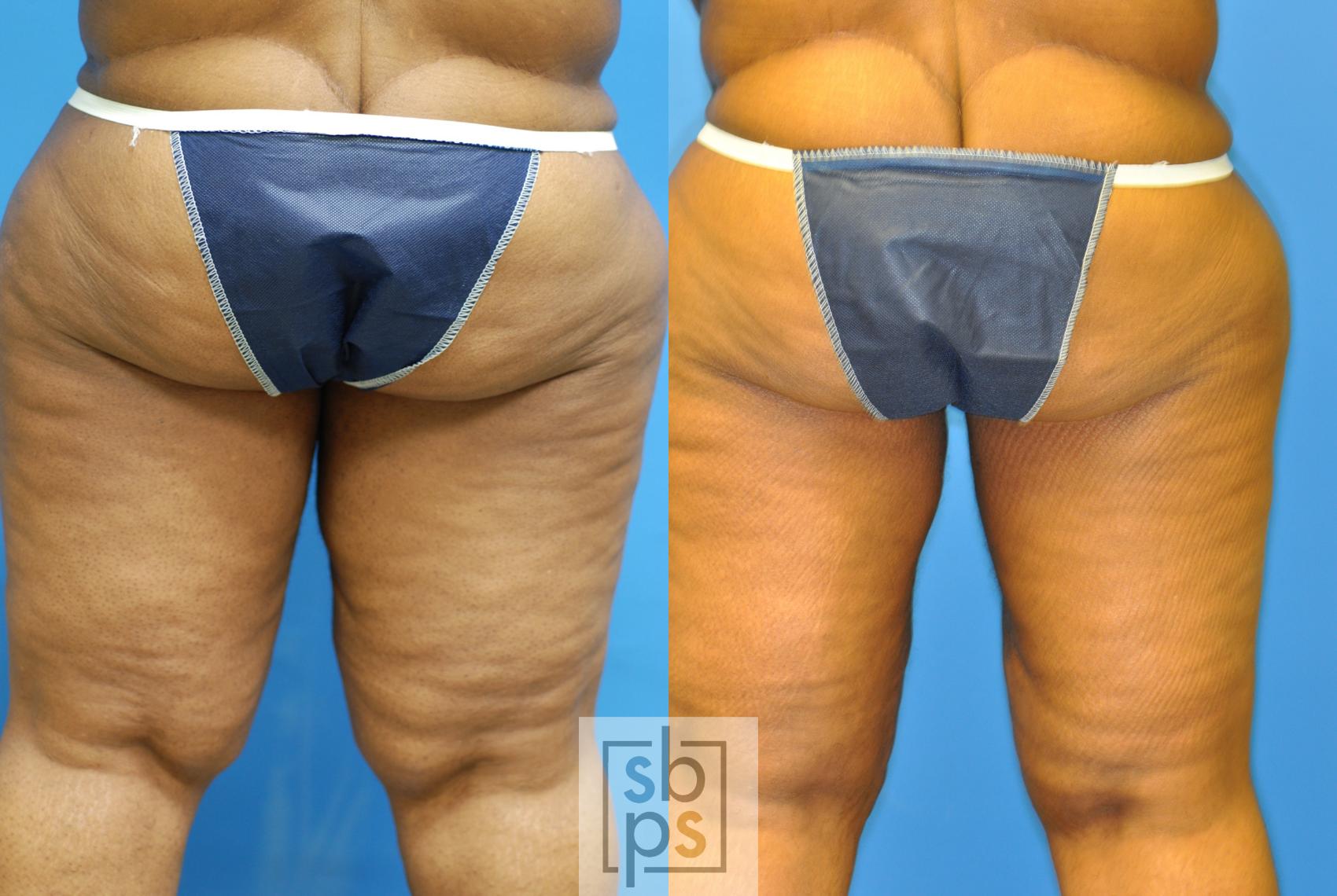 Before & After Liposuction Case 168 View #2 View in Torrance & Los Angeles, CA, CA