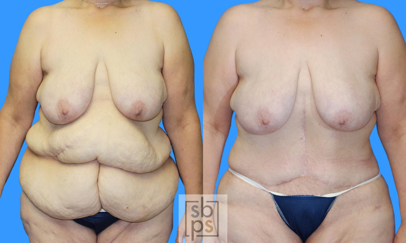 Before & After After Massive Weight Loss Case 181 View #3 View in Torrance, CA