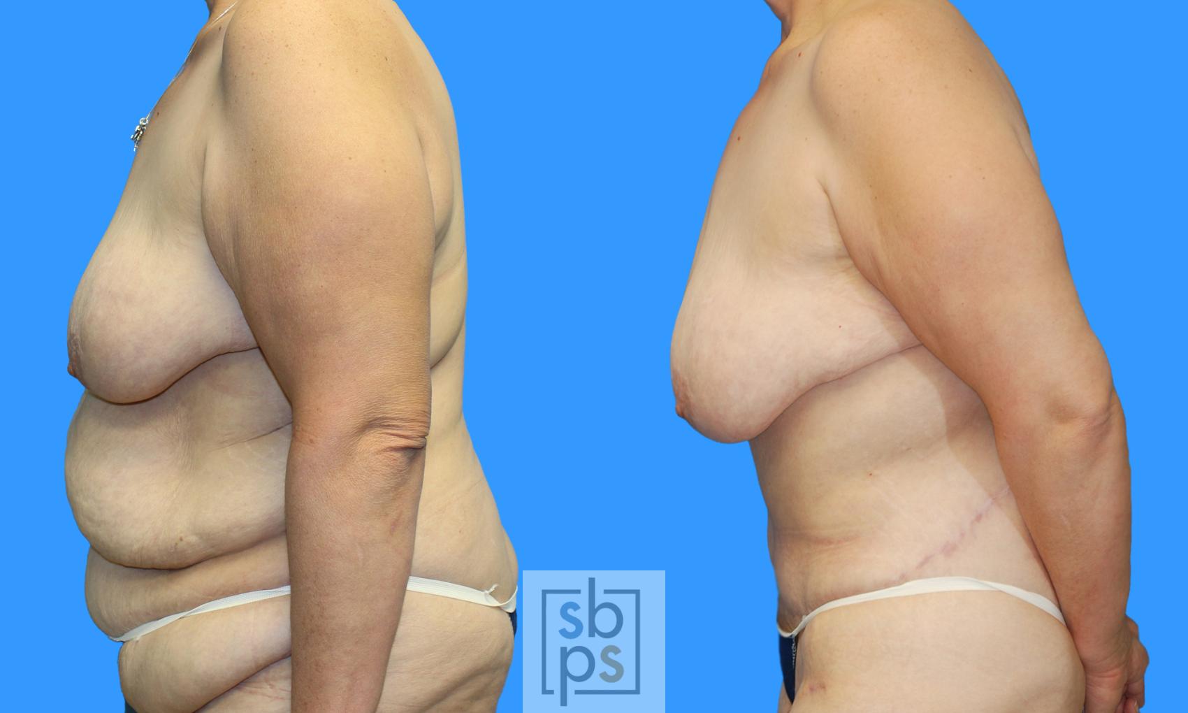 Before & After After Massive Weight Loss Case 181 View #4 View in Torrance & Los Angeles, CA, CA