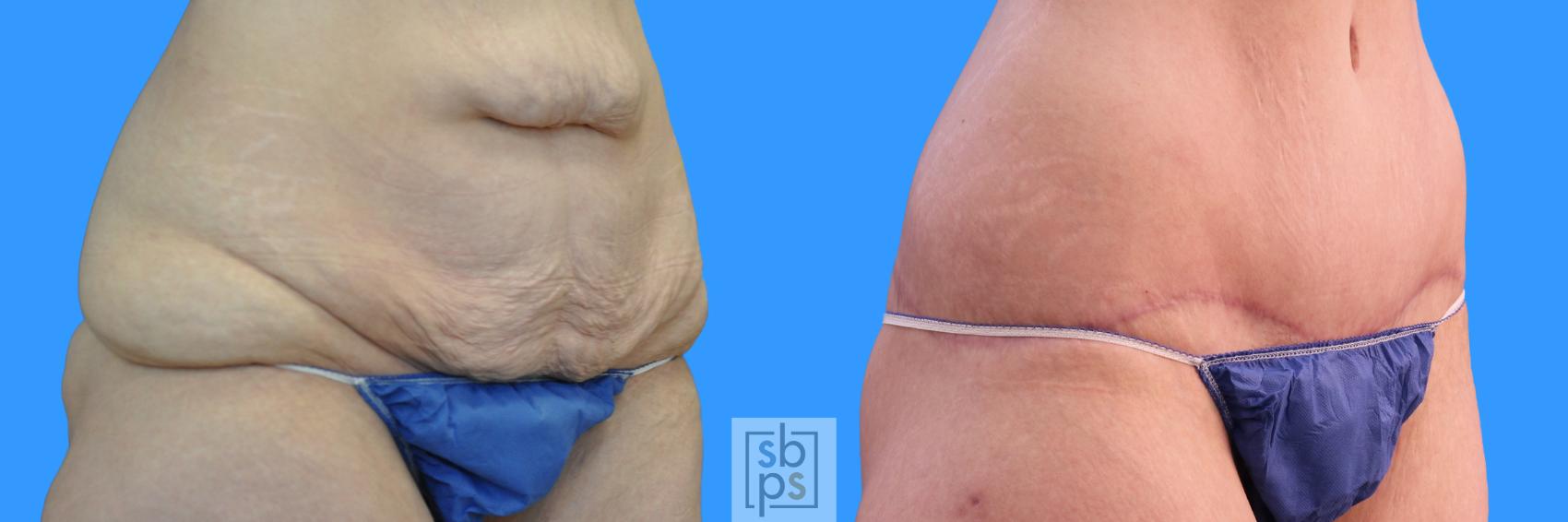 Before & After After Massive Weight Loss Case 225 View #2 View in Torrance & Los Angeles, CA, CA