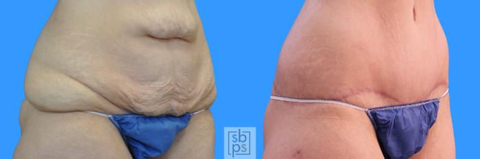 Before & After Tummy Tuck Case 225 View #2 View in Torrance, CA