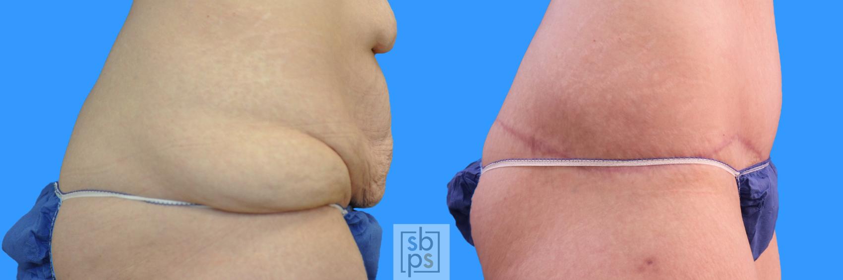 Before & After After Massive Weight Loss Case 225 View #3 View in Torrance & Los Angeles, CA, CA