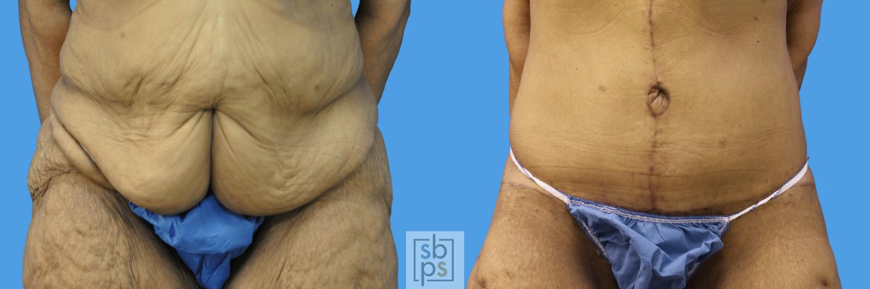Before & After After Massive Weight Loss Case 236 View #1 View in Torrance, CA