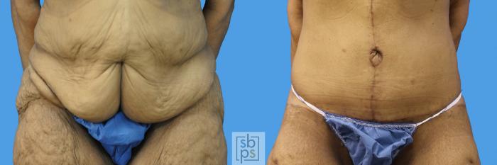 Before & After Abdominoplasty to remove hanging skin - Dr