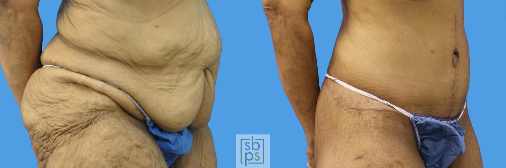 Before & After After Massive Weight Loss Case 236 View #2 View in Torrance & Los Angeles, CA, CA