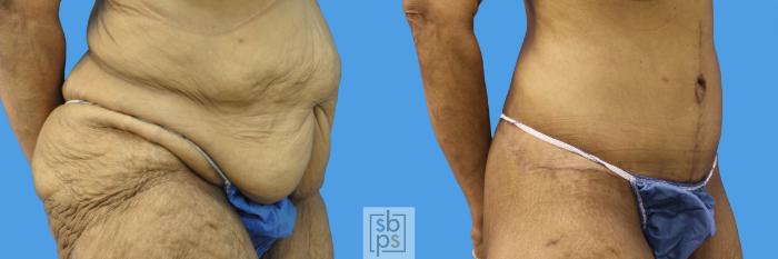 Before & After Tummy Tuck Case 236 View #2 View in Torrance, CA