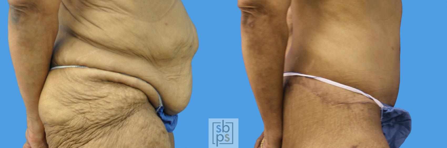 Before & After After Massive Weight Loss Case 236 View #3 View in Torrance & Los Angeles, CA, CA