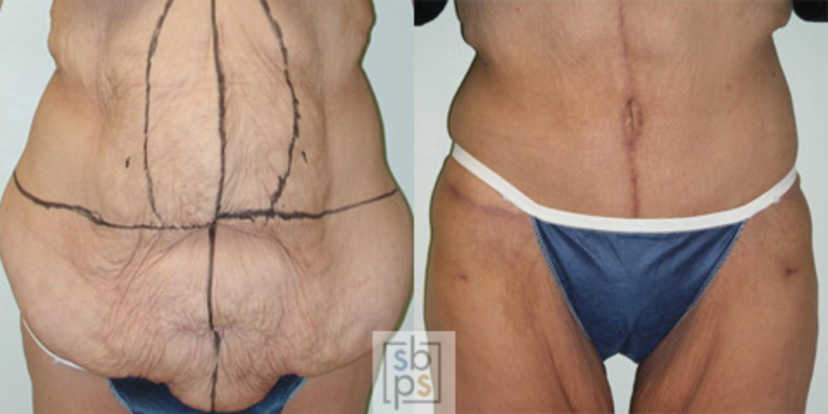 Before & After After Massive Weight Loss Case 31 View #2 View in Torrance & Los Angeles, CA, CA