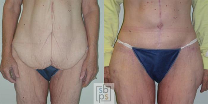 Before & After After Massive Weight Loss Case 32 View #1 View in Torrance, CA