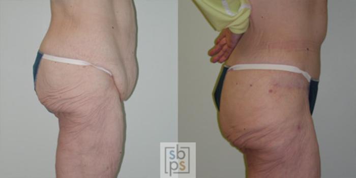 Before & After After Massive Weight Loss Case 32 View #2 View in Torrance, CA