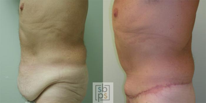 Before & After After Massive Weight Loss Case 33 View #1 View in Torrance, CA