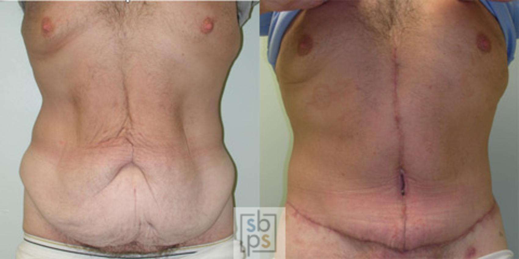 Before & After After Massive Weight Loss Case 33 View #2 View in Torrance & Los Angeles, CA, CA