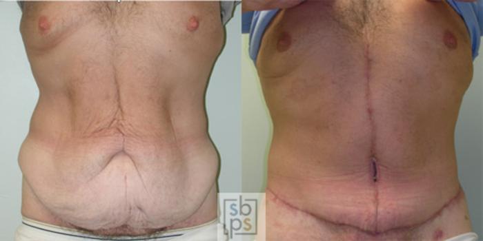 Before & After After Massive Weight Loss Case 33 View #2 View in Torrance, CA