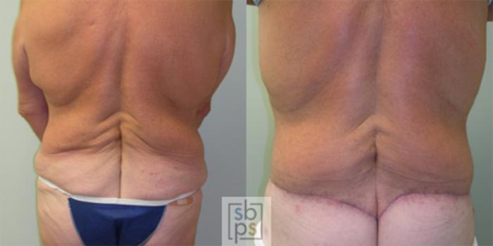 Before & After After Massive Weight Loss Case 33 View #3 View in Torrance, CA