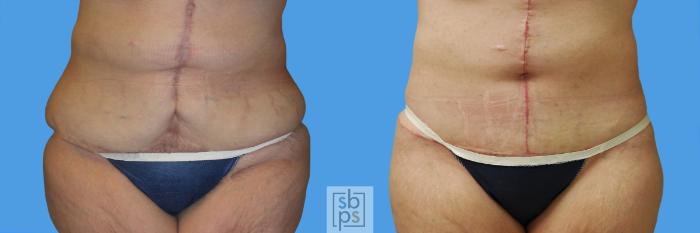 Before & After After Massive Weight Loss Case 58 View #1 View in Torrance, CA