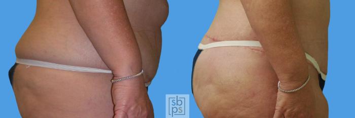 Before & After After Massive Weight Loss Case 58 View #2 View in Torrance, CA