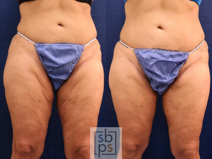 Before & After After Massive Weight Loss Case 608 Front View in Torrance, CA