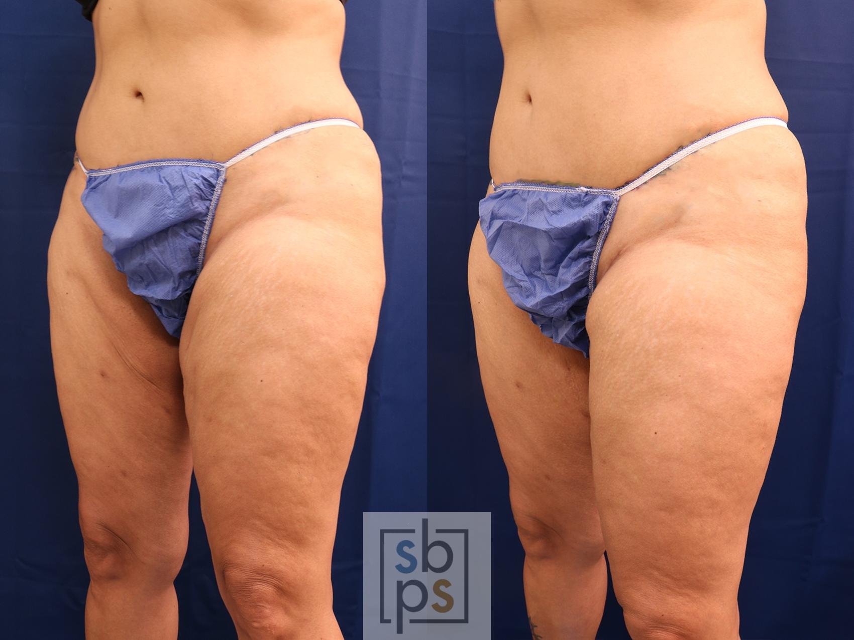 Before & After After Massive Weight Loss Case 608 Left Oblique View in Torrance & Los Angeles, CA, CA