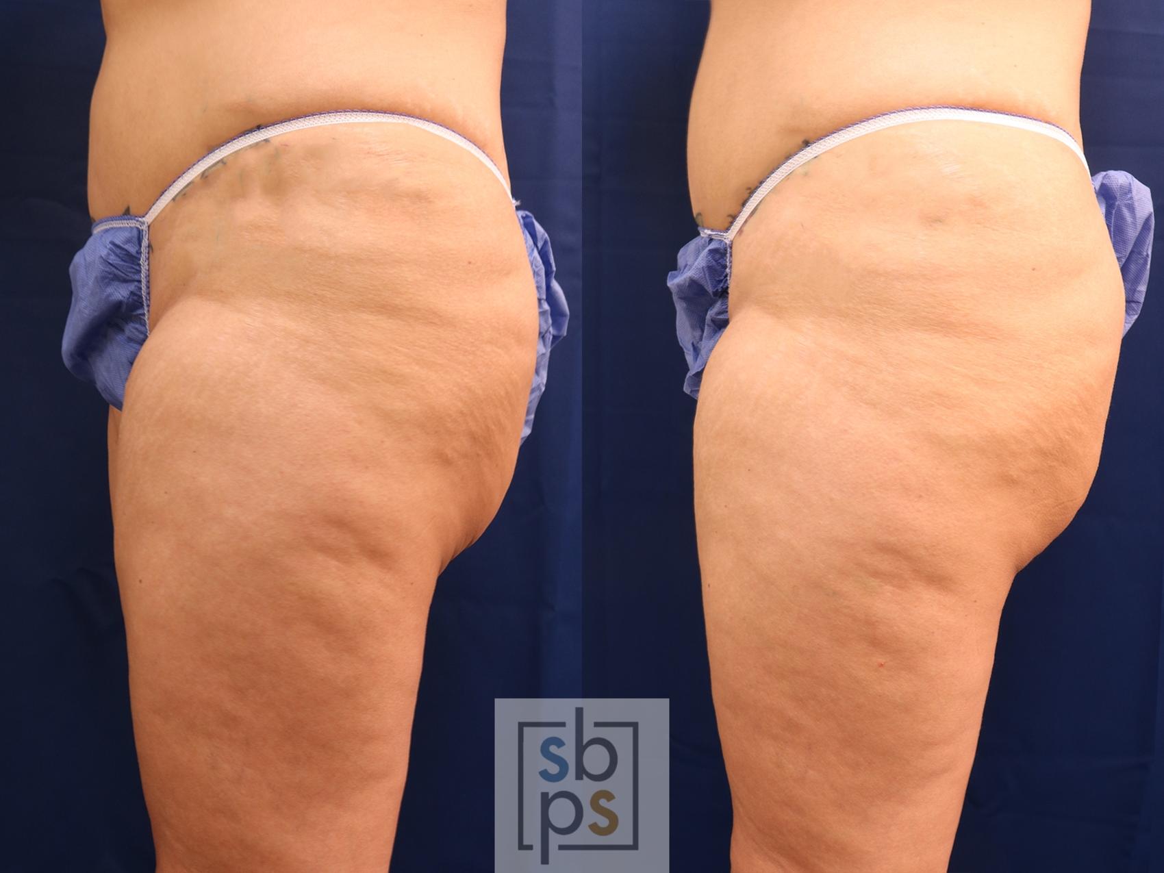Before & After After Massive Weight Loss Case 608 Left Side View in Torrance & Los Angeles, CA, CA