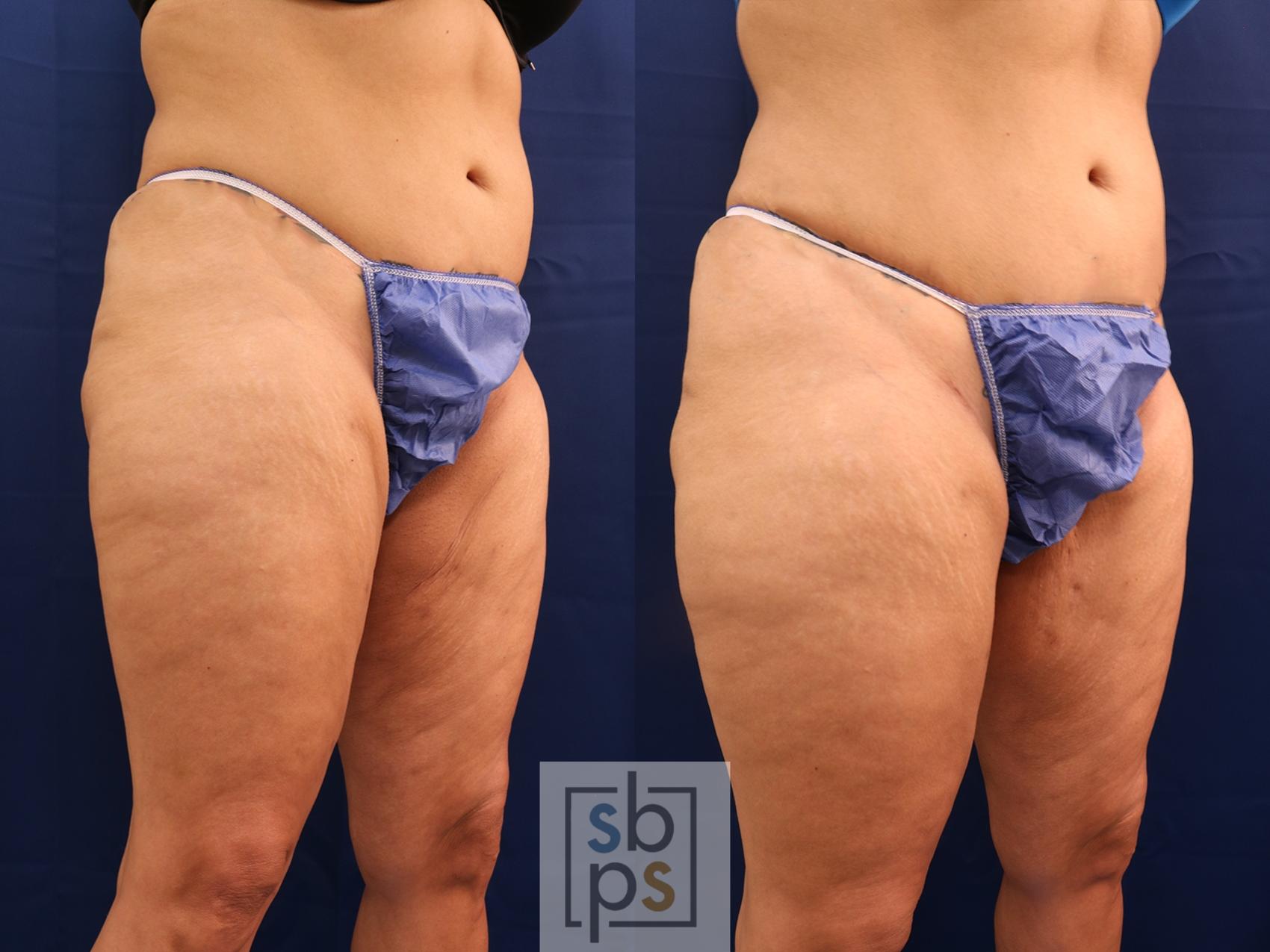 Before & After After Massive Weight Loss Case 608 Right Oblique View in Torrance & Los Angeles, CA, CA