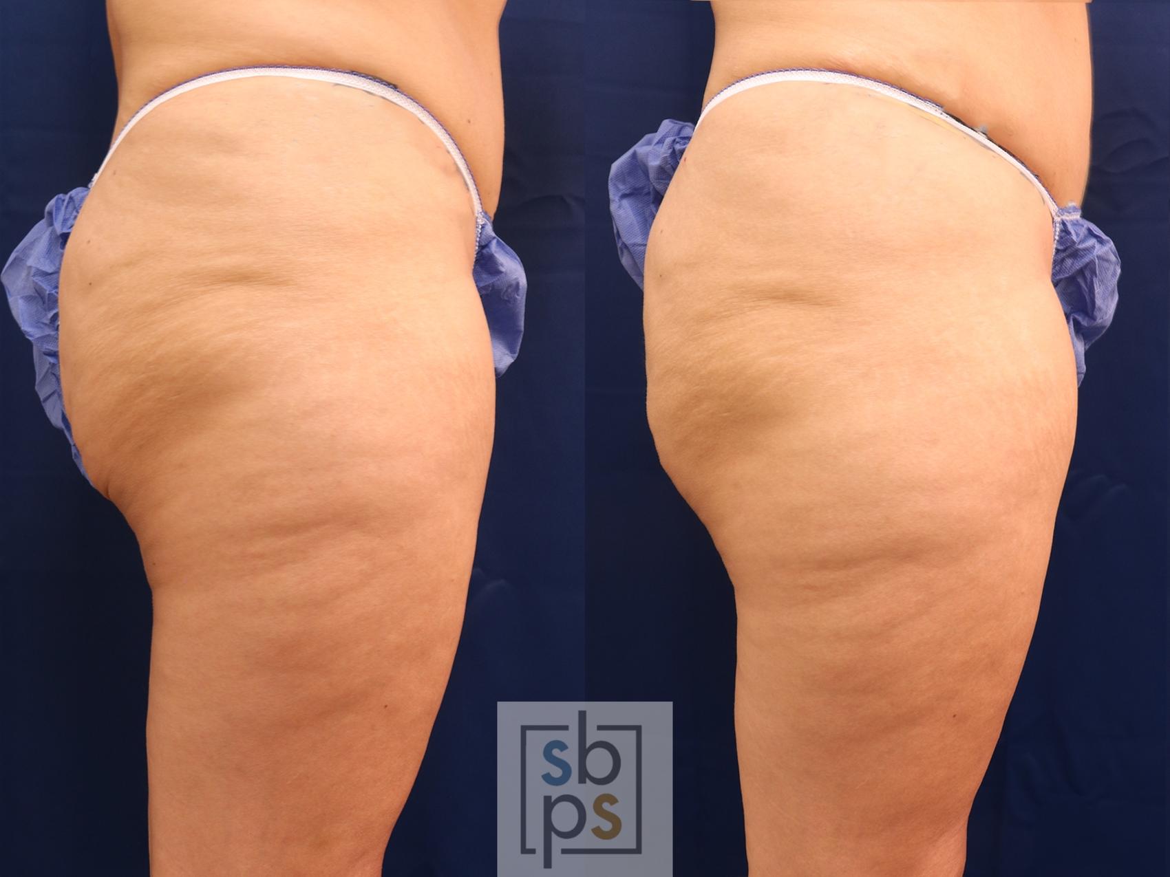 Before & After After Massive Weight Loss Case 608 Right Side View in Torrance & Los Angeles, CA, CA