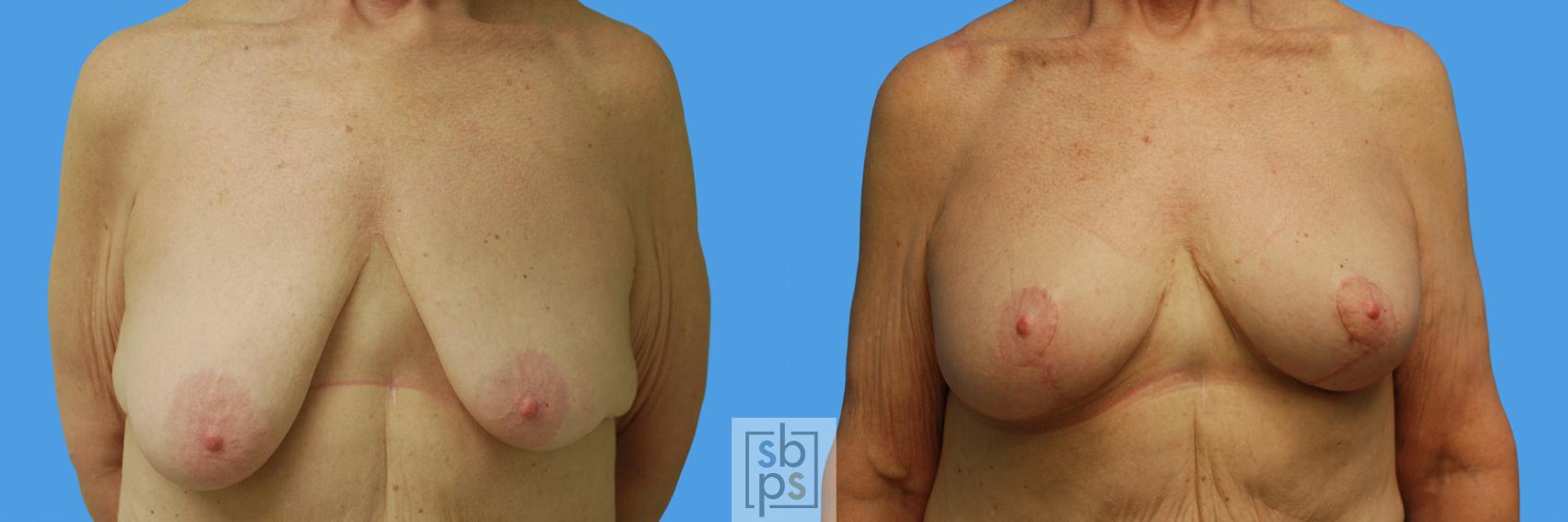 Before & After Breast Lift Case 62 View #6 View in Torrance, CA