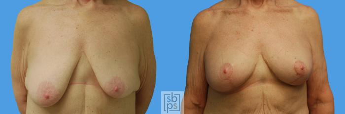 Before & After Breast Lift Case 62 View #6 View in Torrance, CA