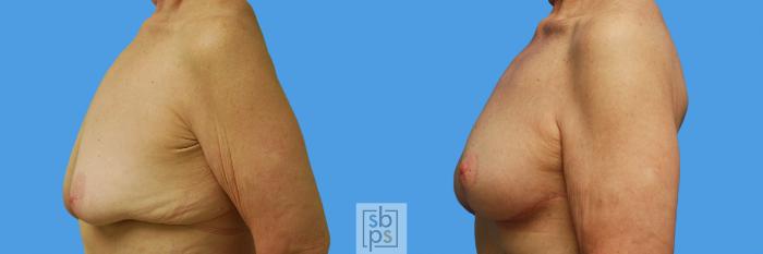 Before & After Breast Lift Case 62 View #7 View in Torrance, CA