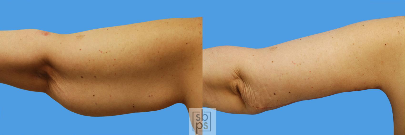 Before & After Arm Lift Case 64 View #5 View in Torrance, CA