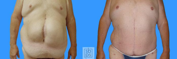 Before & After Tummy Tuck Case 65 View #3 View in Torrance, CA