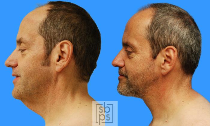 Before & After Neck Lift Case 68 View #3 View in Torrance, CA