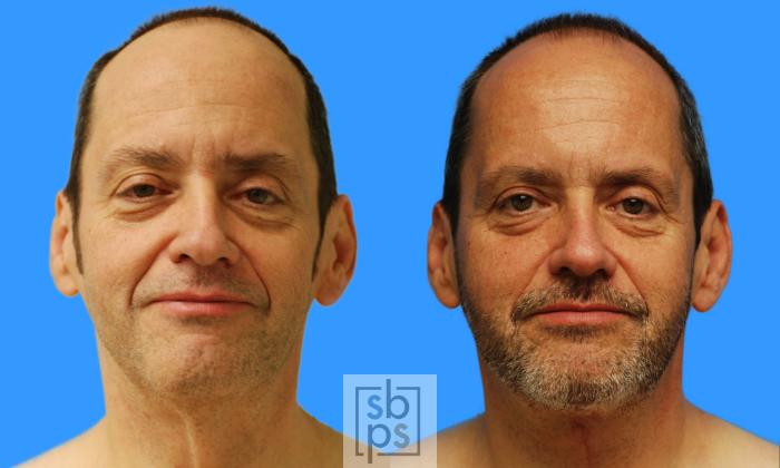 Before & After Neck Lift Case 68 View #4 View in Torrance, CA