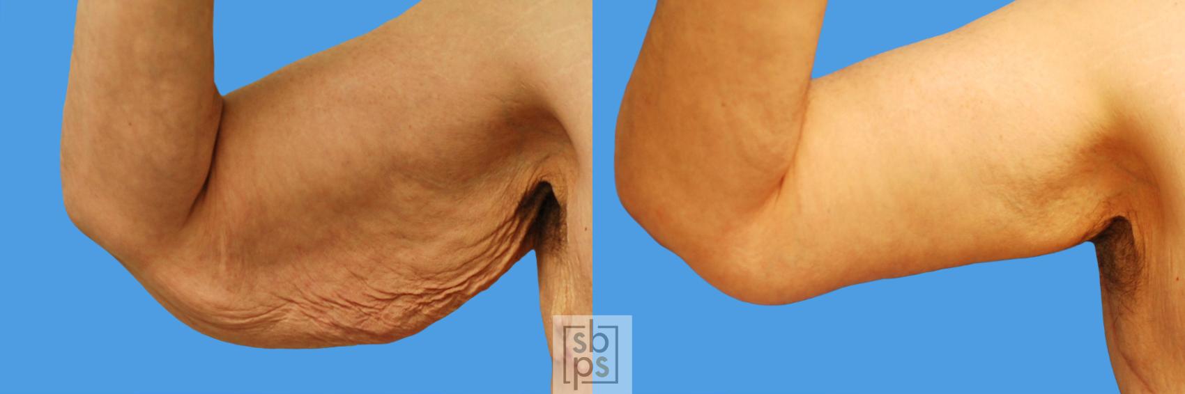 Before & After Arm Lift Case 71 View #1 View in Torrance, CA